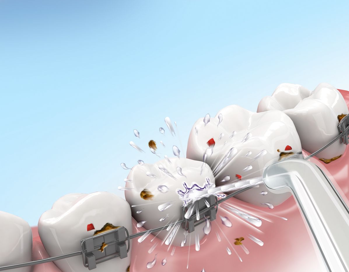 Idropulsore in ortodonzia